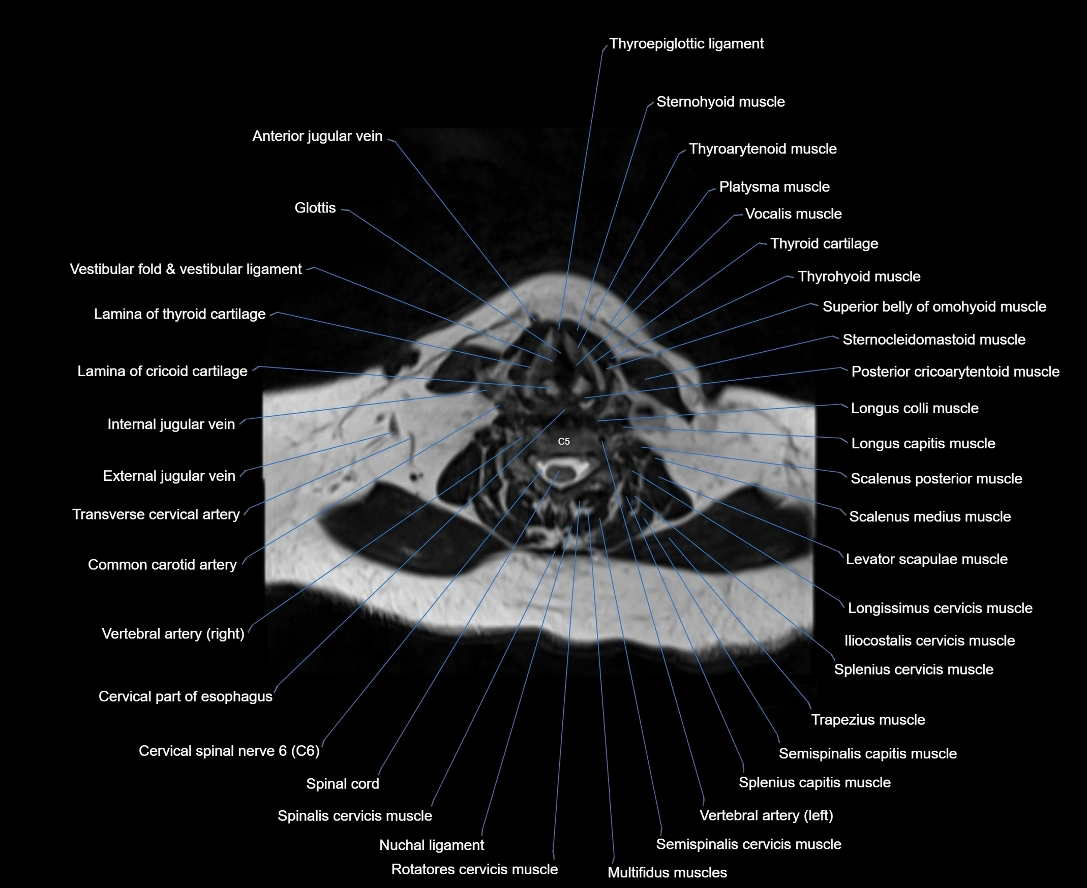 MRI Neck 3D labelled cross section anatomy axial 3t image-00001-00060.webp
